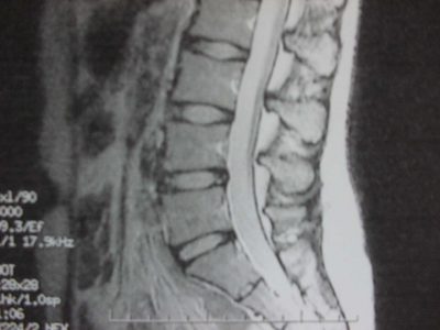 椎間板ヘルニア＿正常な腰椎のMRI