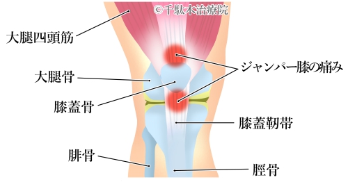 膝の痛み＿膝自体が悪い。(靭帯や半月板などを傷めている）