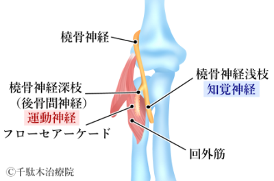 後骨間神経麻痺