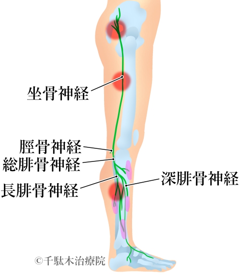 坐骨神経痛 文京区の接骨 鍼灸 整体の総合治療院 千駄木治療院