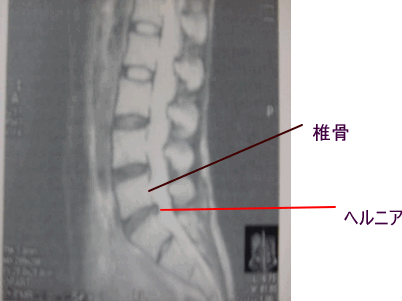 椎間板ヘルニア＿変性を起こした状態のMRI