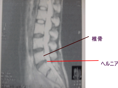 椎間板ヘルニア 文京区の接骨 鍼灸 整体の総合治療院 千駄木治療院